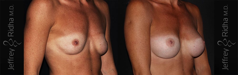 Breast Augmentation Before and After - Case 22