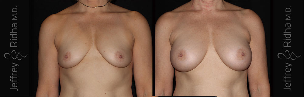Breast Augmentation Before and After - Case 23
