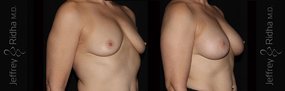 Breast Augmentation Before and After - Case 23