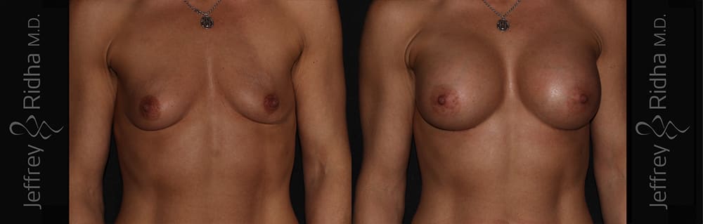Breast Augmentation Before and After - Case 25