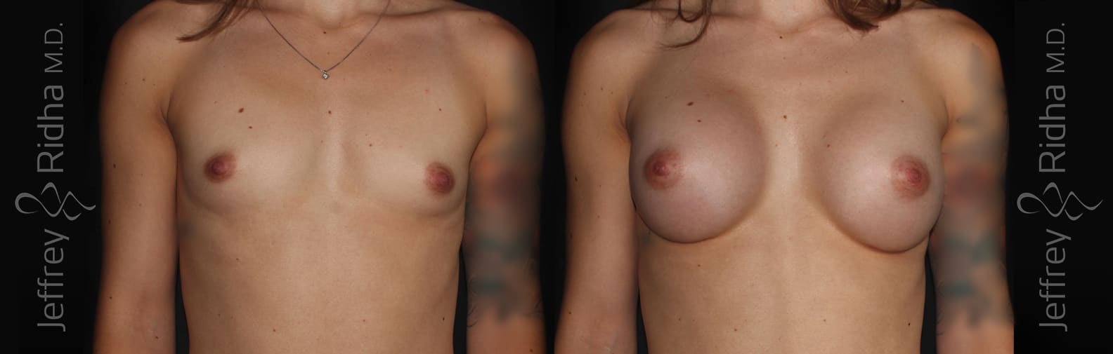 Breast Augmentation Before and After - Case 27