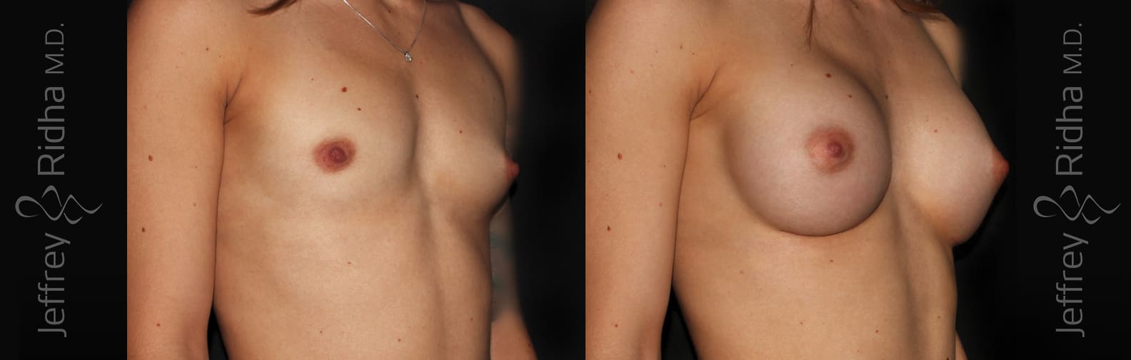 Breast Augmentation Before and After - Case 27