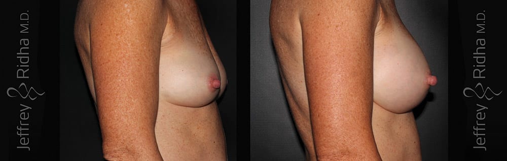 Breast Augmentation Before and After - Case 28