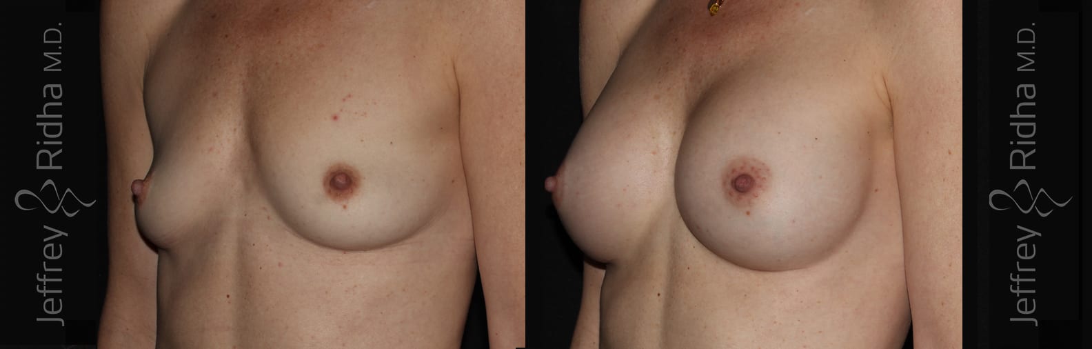 Breast Augmentation Before and After - Case 29
