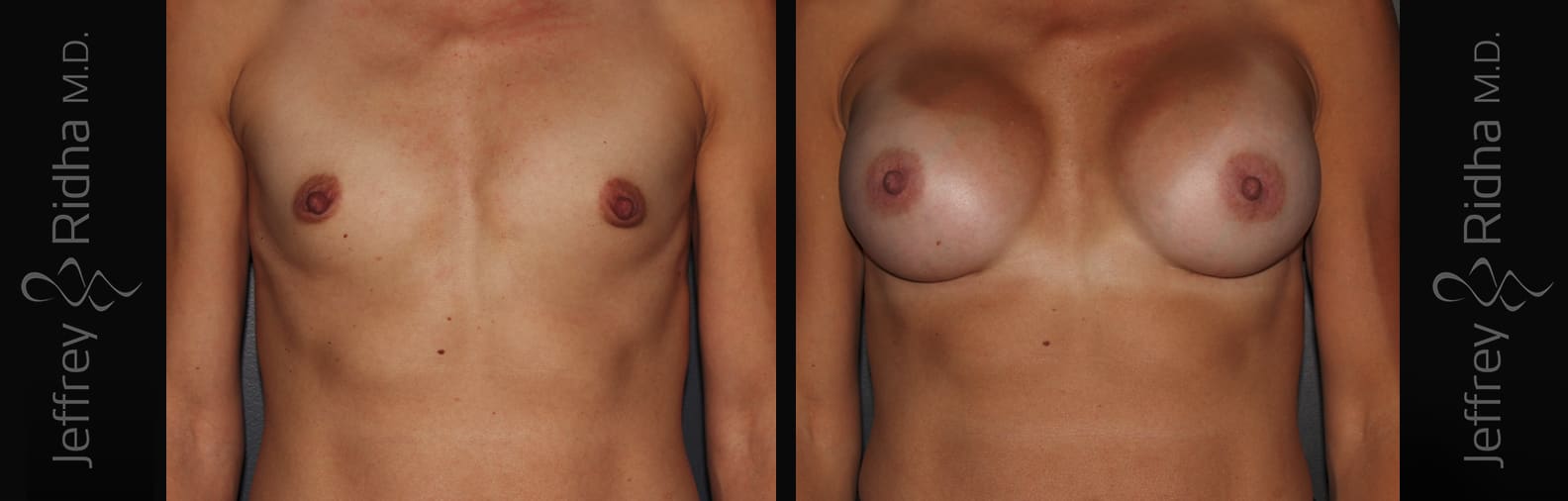 Breast Augmentation Before and After - Case 30