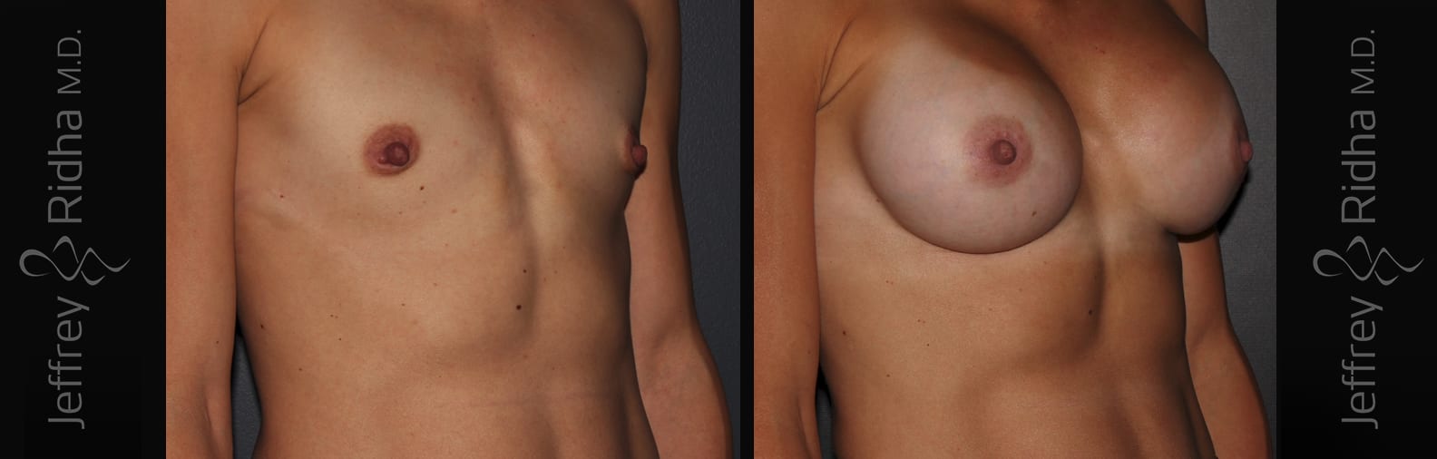 Breast Augmentation Before and After - Case 30