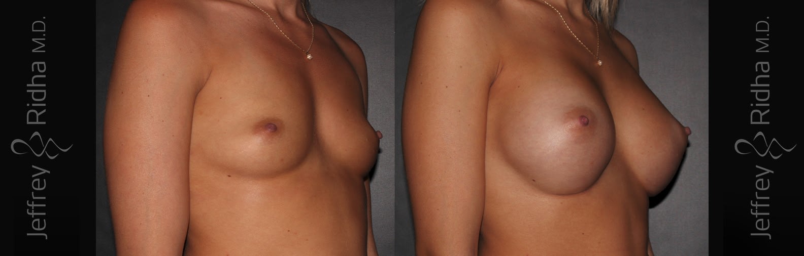Breast Augmentation Before and After - Case 31