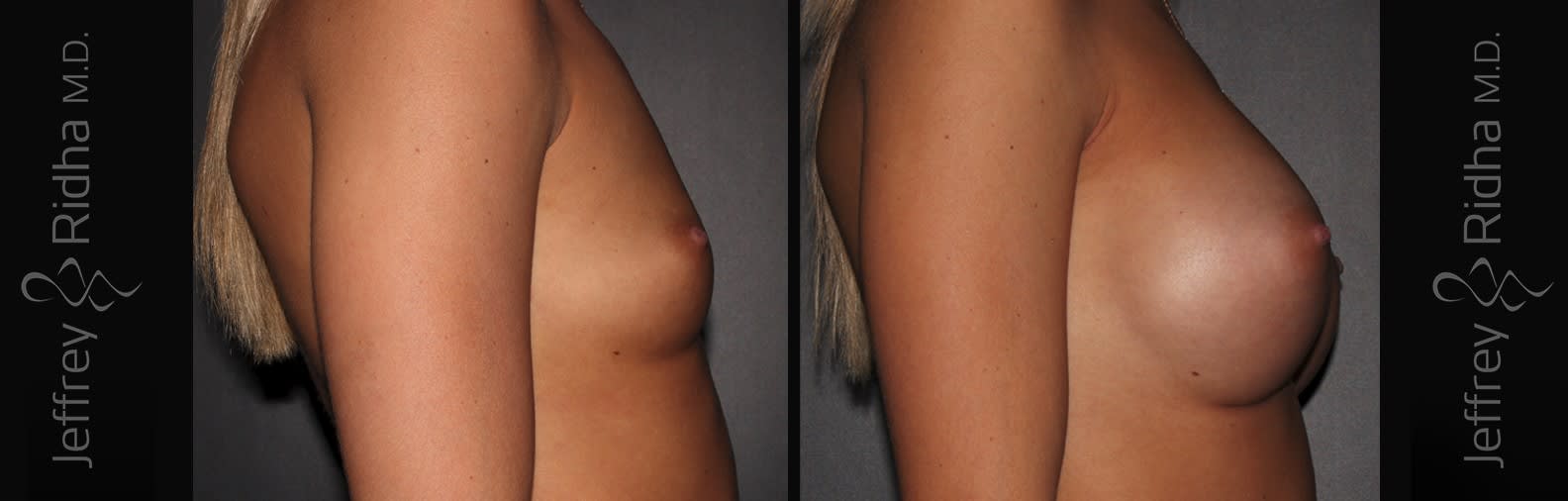 Breast Augmentation Before and After - Case 31