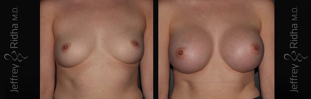 Breast Augmentation Before and After - Case 32