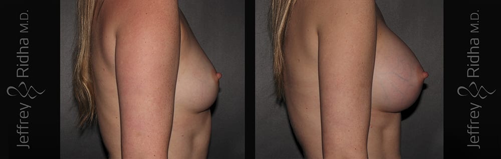Breast Augmentation Before and After - Case 32