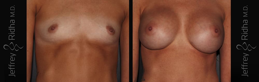 Breast Augmentation Before and After - Case 33