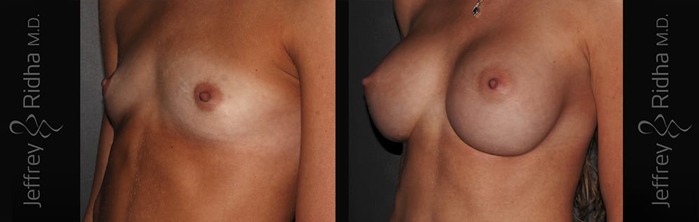 Breast Augmentation Before and After - Case 33