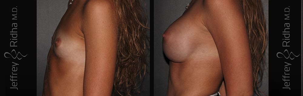 Breast Augmentation Before and After - Case 33