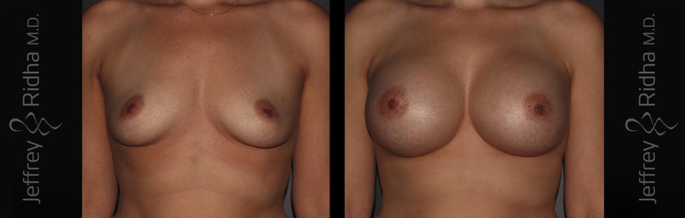 Breast Augmentation Before and After - Case 34