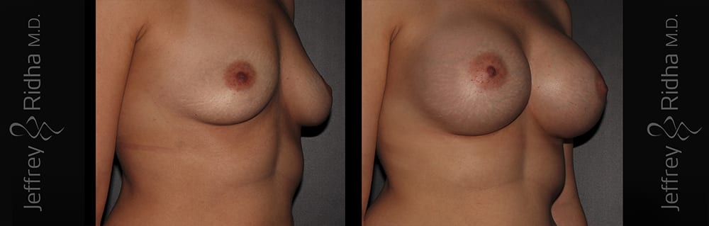 Breast Augmentation Before and After - Case 34