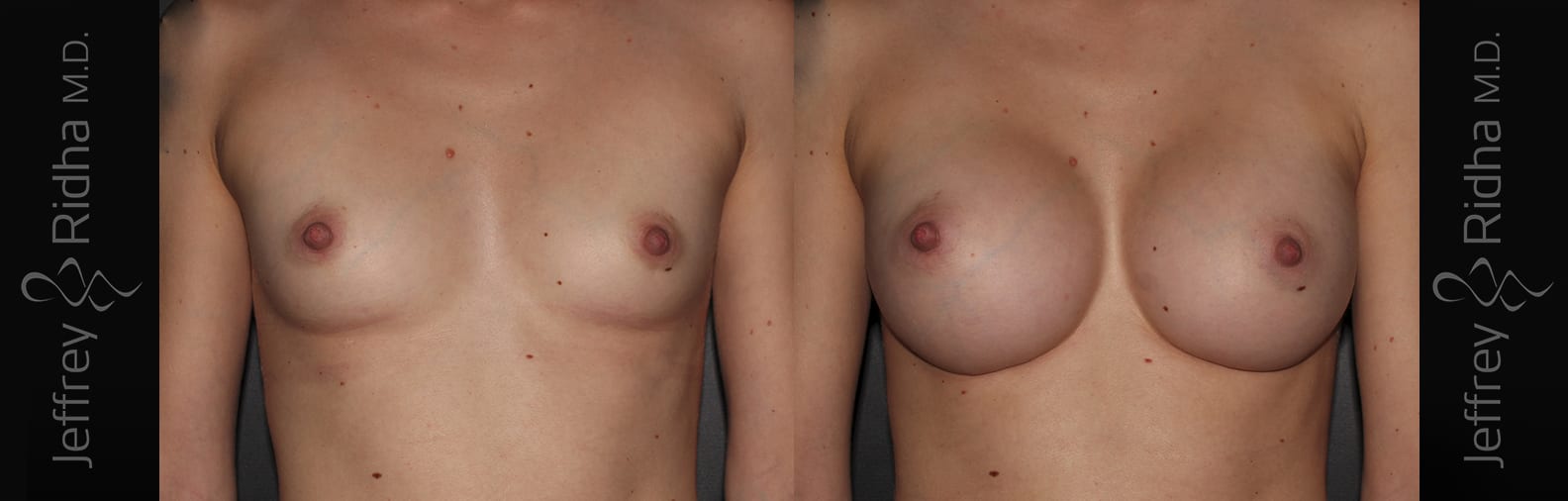 Breast Augmentation Before and After - Case 35