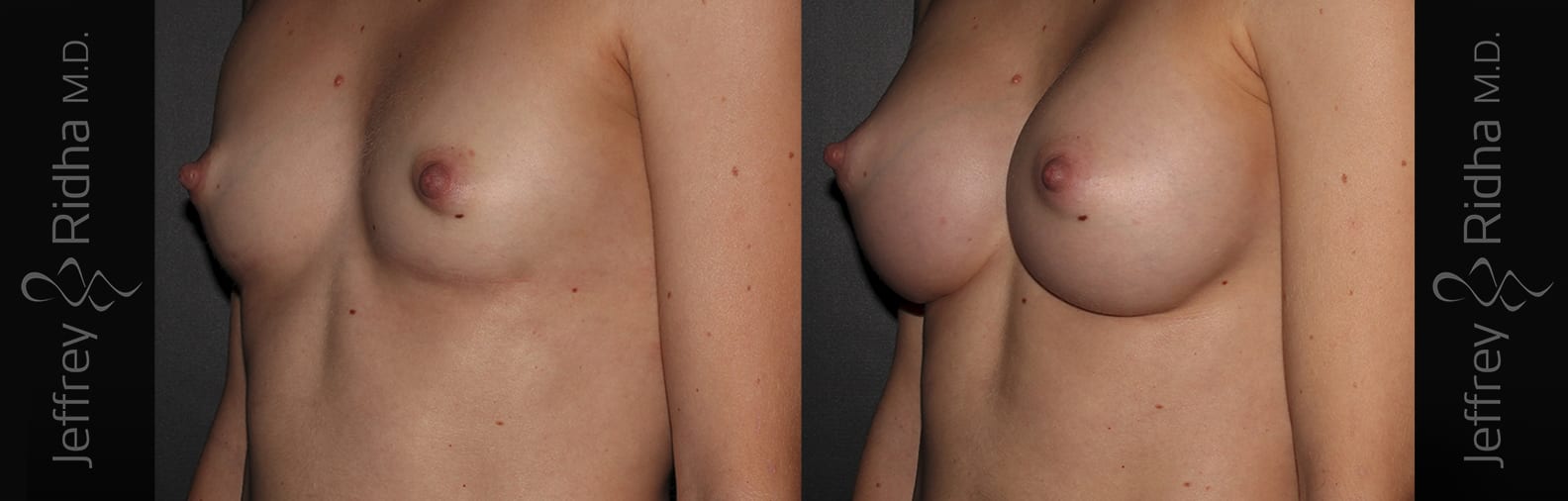 Breast Augmentation Before and After - Case 35