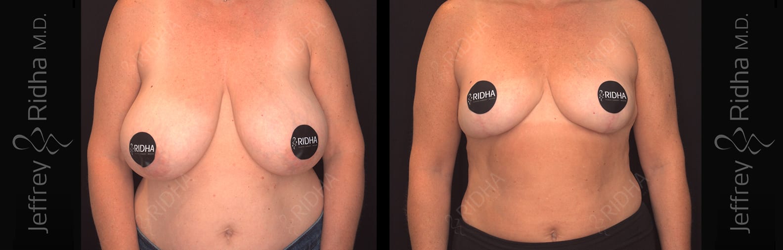 Breast Reduction Before and After - Case 1