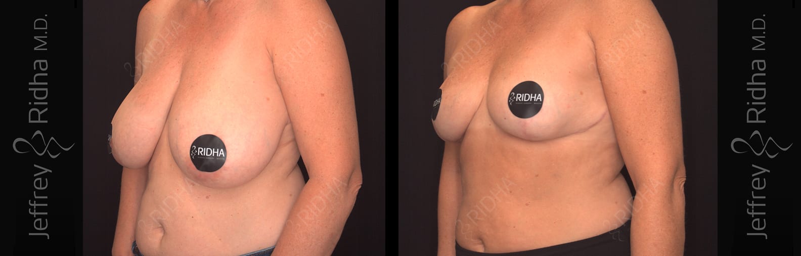Breast Reduction Before and After - Case 1