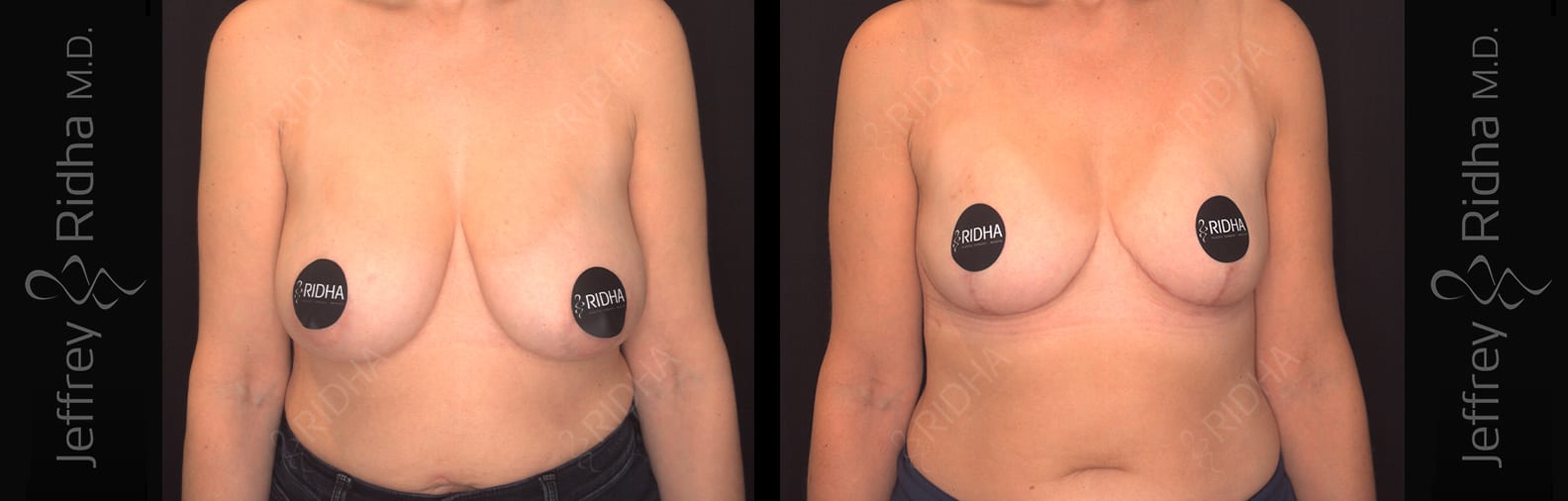Breast Reduction Before and After - Case 2
