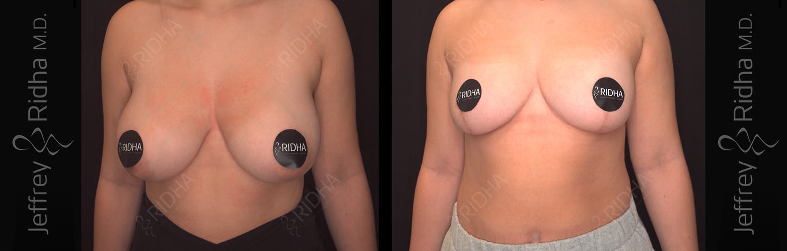 Breast Reduction Before and After - Case 3