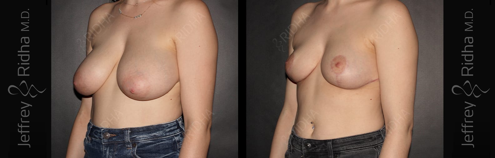 Breast Reduction Before and After - Case 4