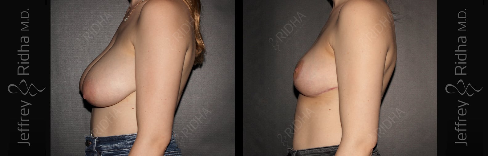 Breast Reduction Before and After - Case 4