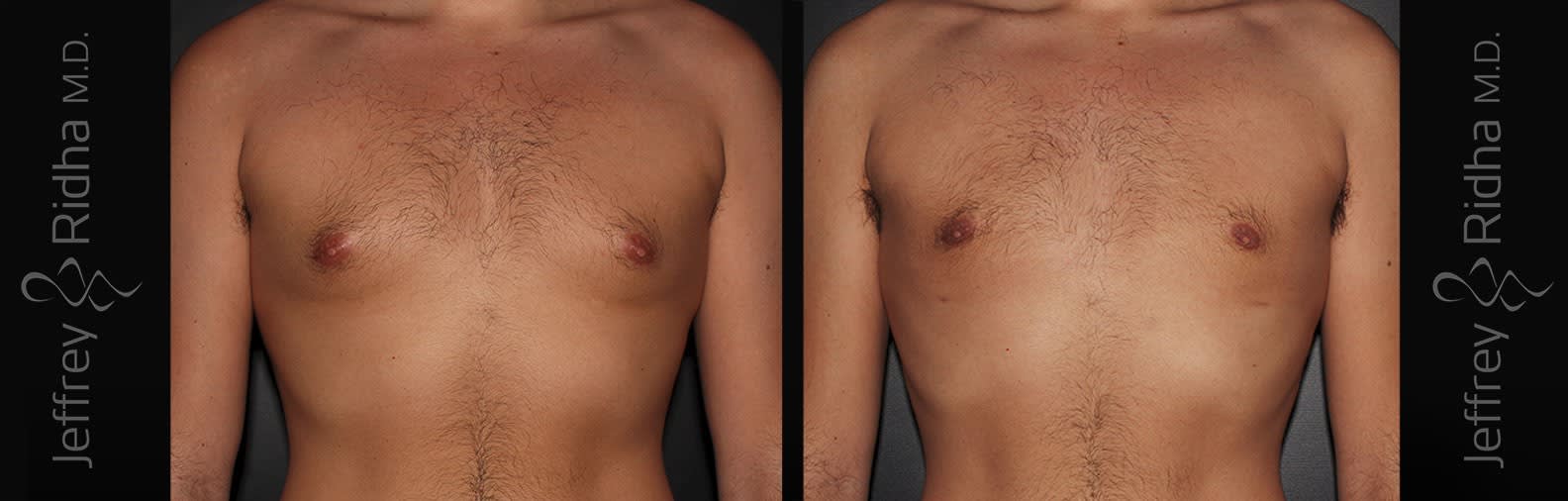 Gynecomastia Before and After - Case 1