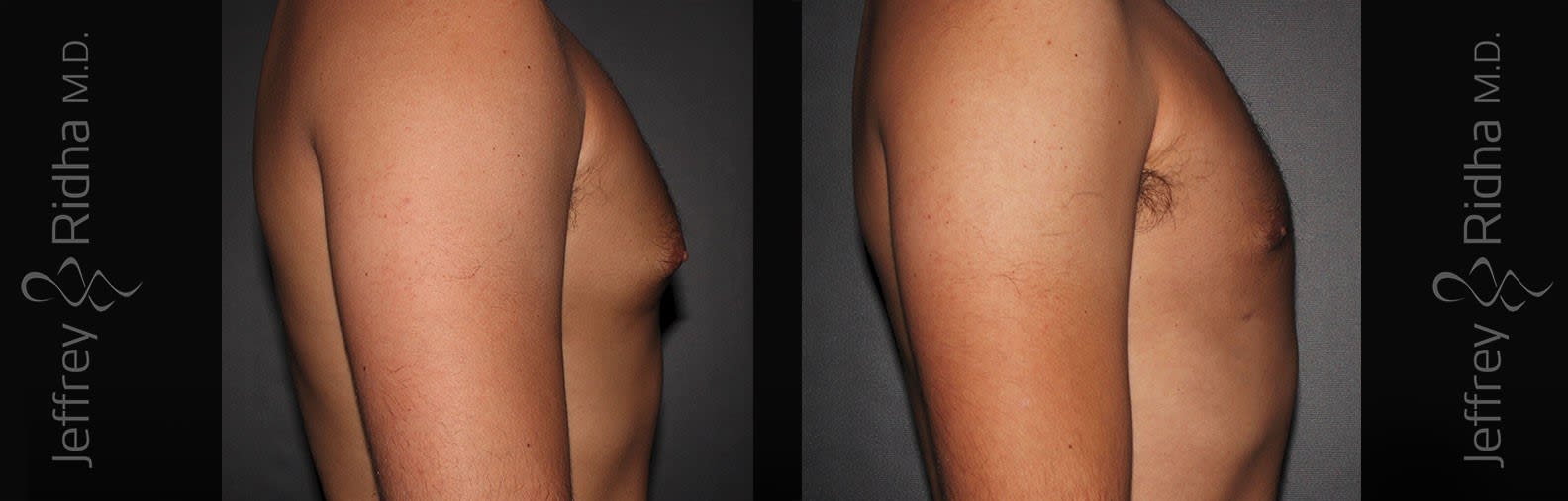 Gynecomastia Before and After - Case 1