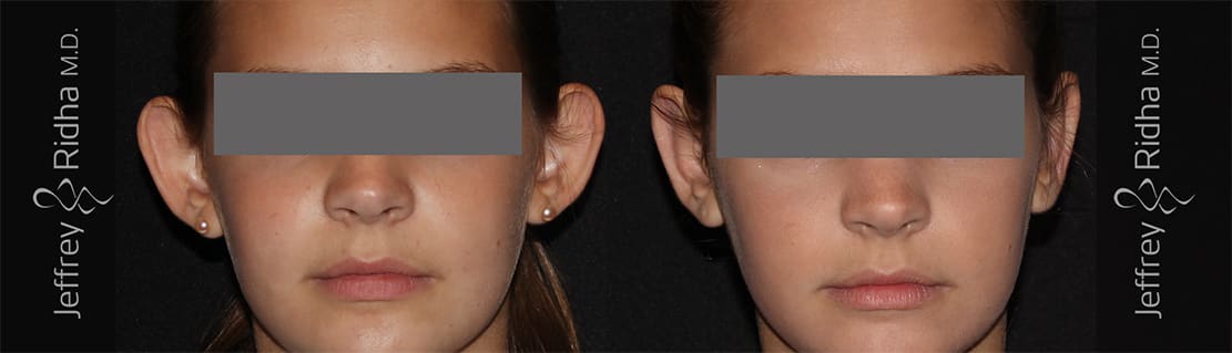 Otoplasty Before and After - Case 1