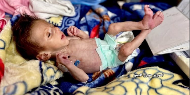 WHO: Anak-anak Gaza Meninggal Akibat Kelaparan