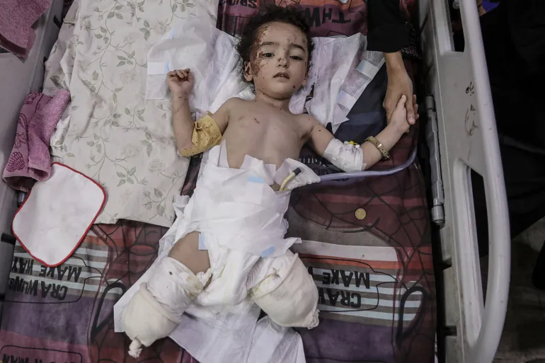 PBB: 10 Anak Kehilangan Kaki Setiap Hari di Gaza