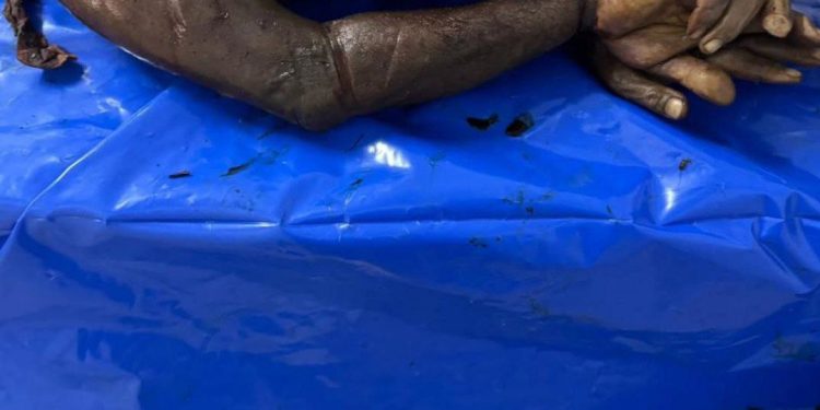 Dokter Inggris Konfirmasi Israel Lakukan Pencurian Organ Jenazah Palestina