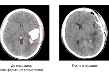Врачи спасли 18-летнего россиянина с гематомой в мозге