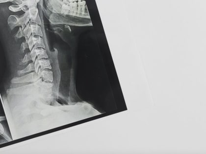 Подмосковье закупит передвижные рентгеновские аппараты типа С-дуга на 224 млн рублей