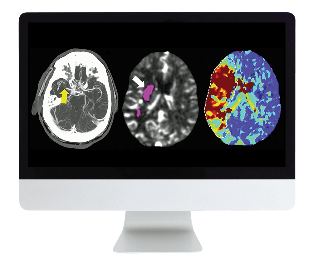ARRS Code Stroke: What Every Radiologist Should Know 2022