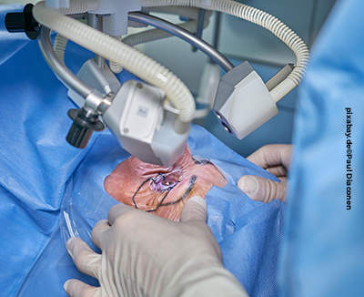 Ein chirurgischer Eingriff am Auge wird durchgeführt. Der Patient liegt unter einem Mikroskop, während der Chirurg mit sterilen Handschuhen präzise operiert.