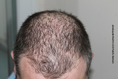 Haartransplantationen haben keine medizinische Notwendigkeit, sind aber gut für das Selbstbewusstsein.