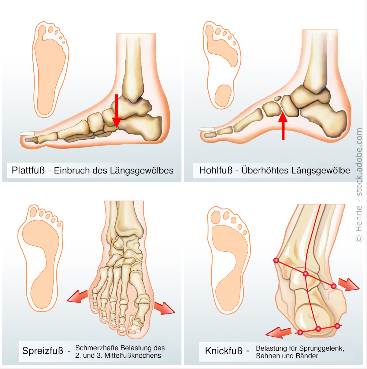 Plattfuß Hohlfuß Senkfuß Spreizfuß