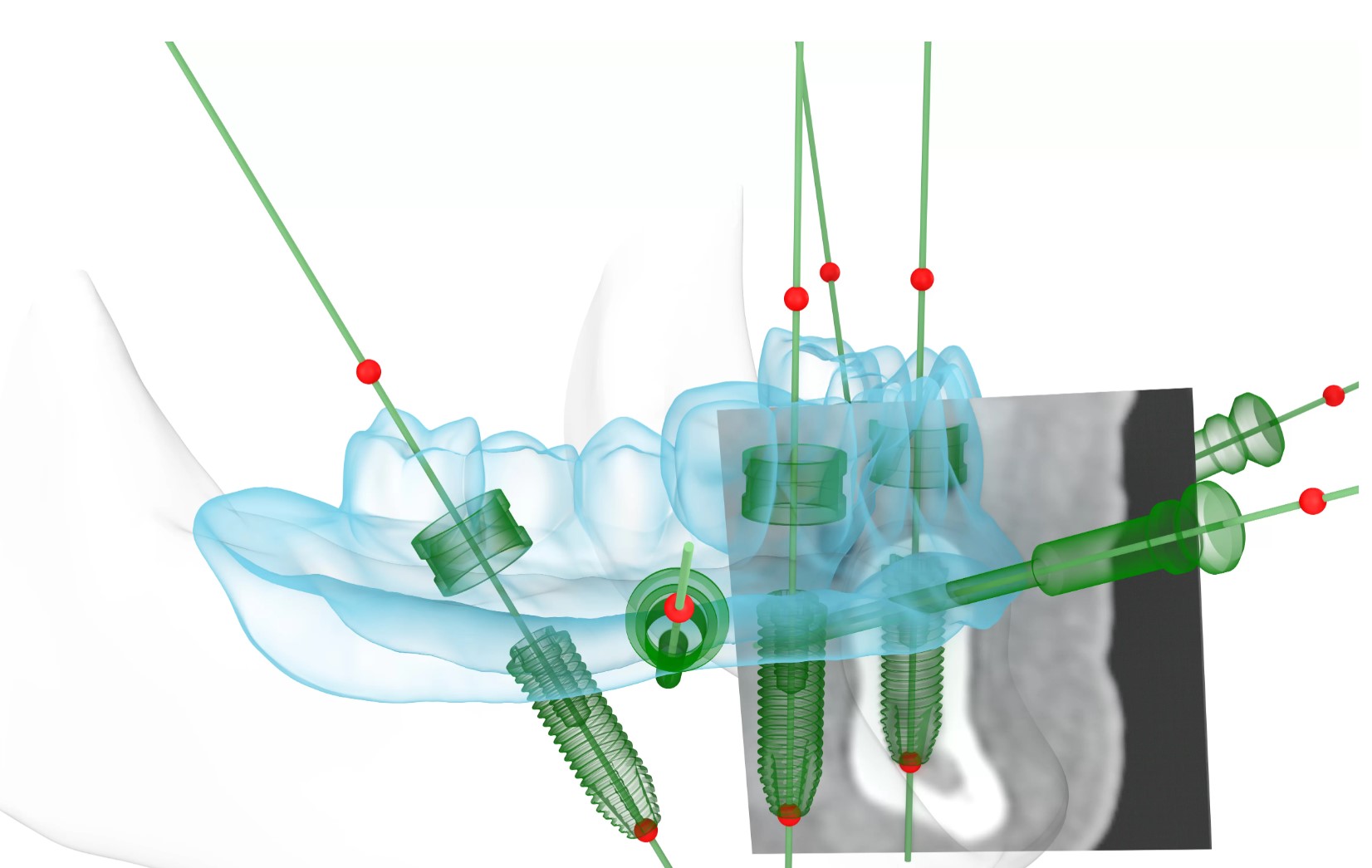 Dentprevent All on 4