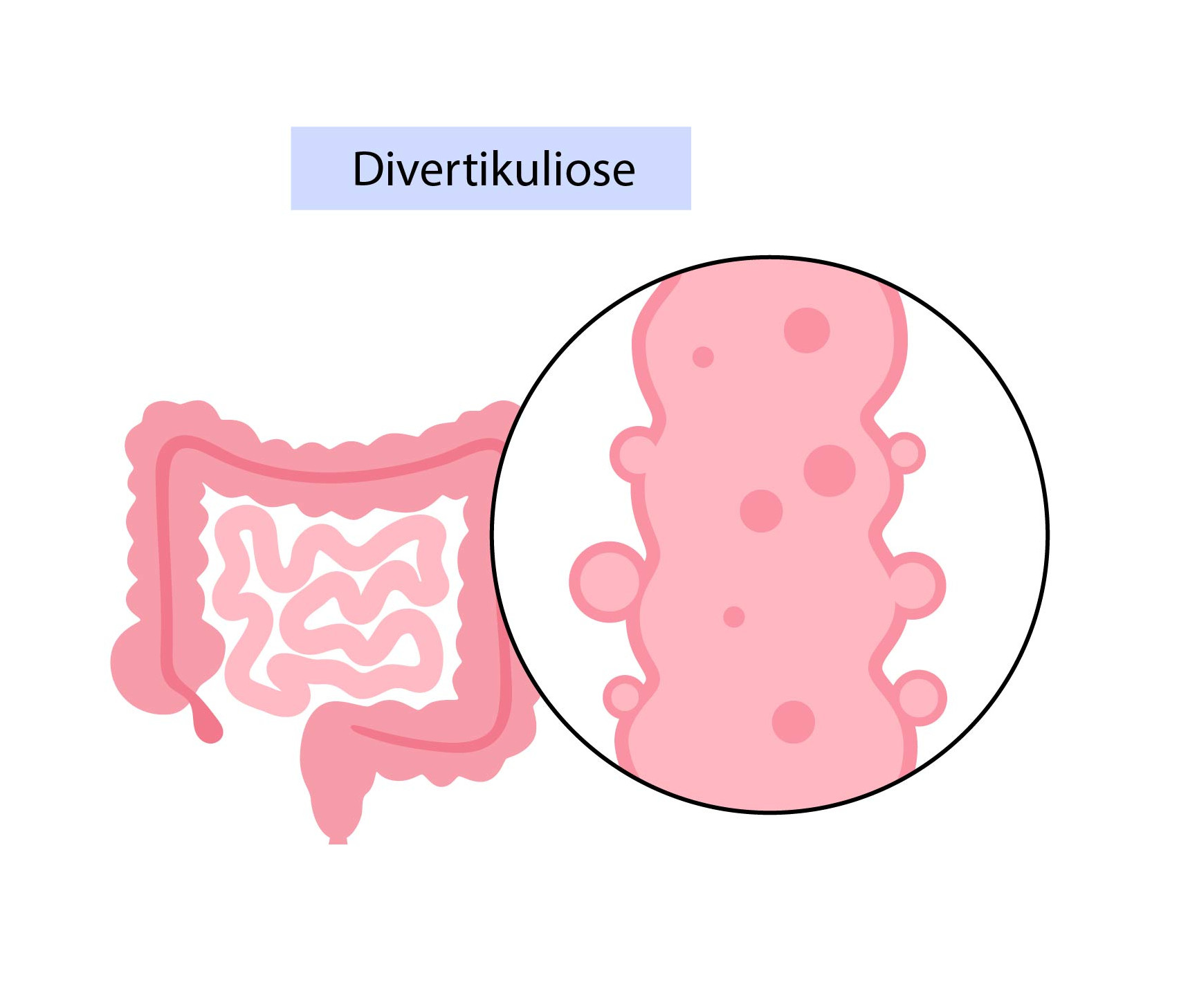 Abbildung Darm mit Nahaufnahme von Divertikeln 