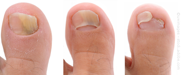 Nagelpilz Verlauf ÄRZTE.DE