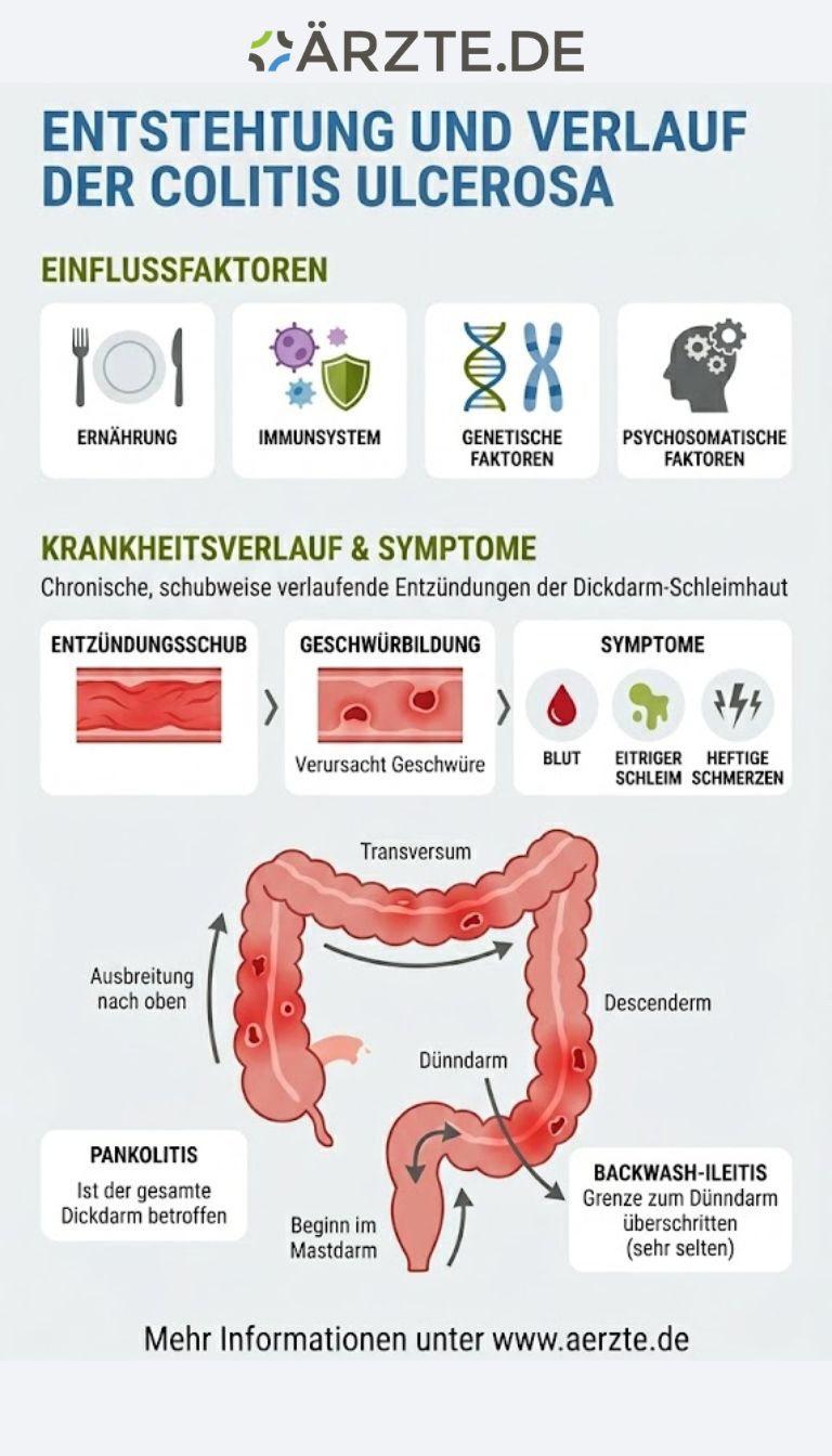 Grafik zu Entstehung und Verlauf der Colitis Ulcerosa