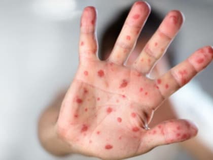 В Тюмени зафиксирован случай кори