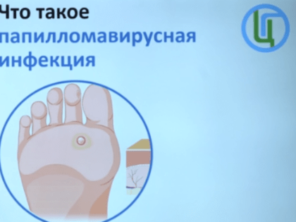 Профилактика вируса папилломы человека