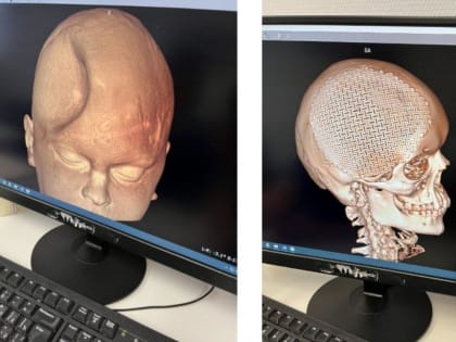 Успешная нейрохирургическая операция в Тюмени