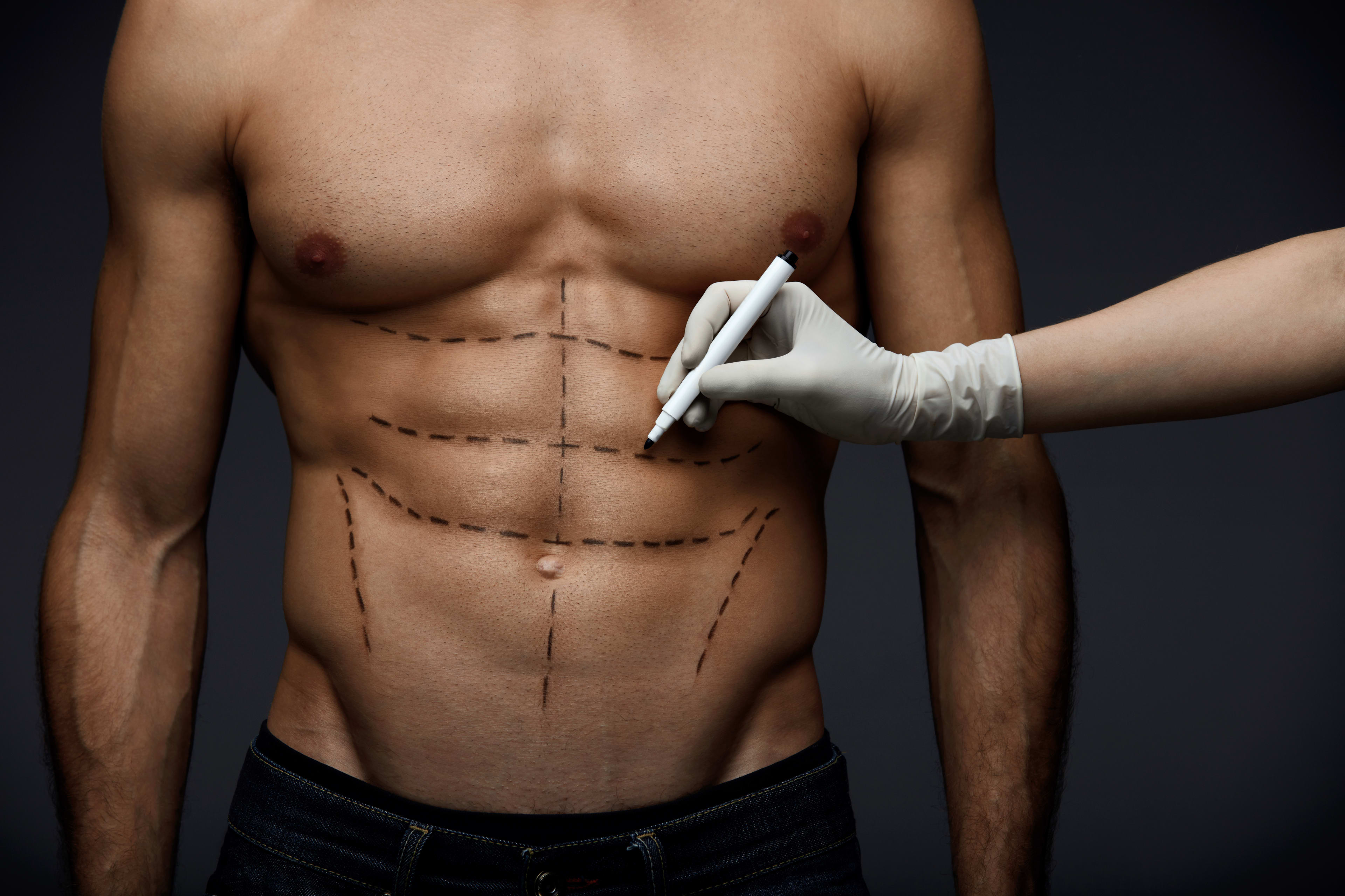 EMSCULPT body contouring treatment room at Allure MD medical spa Newport Beach