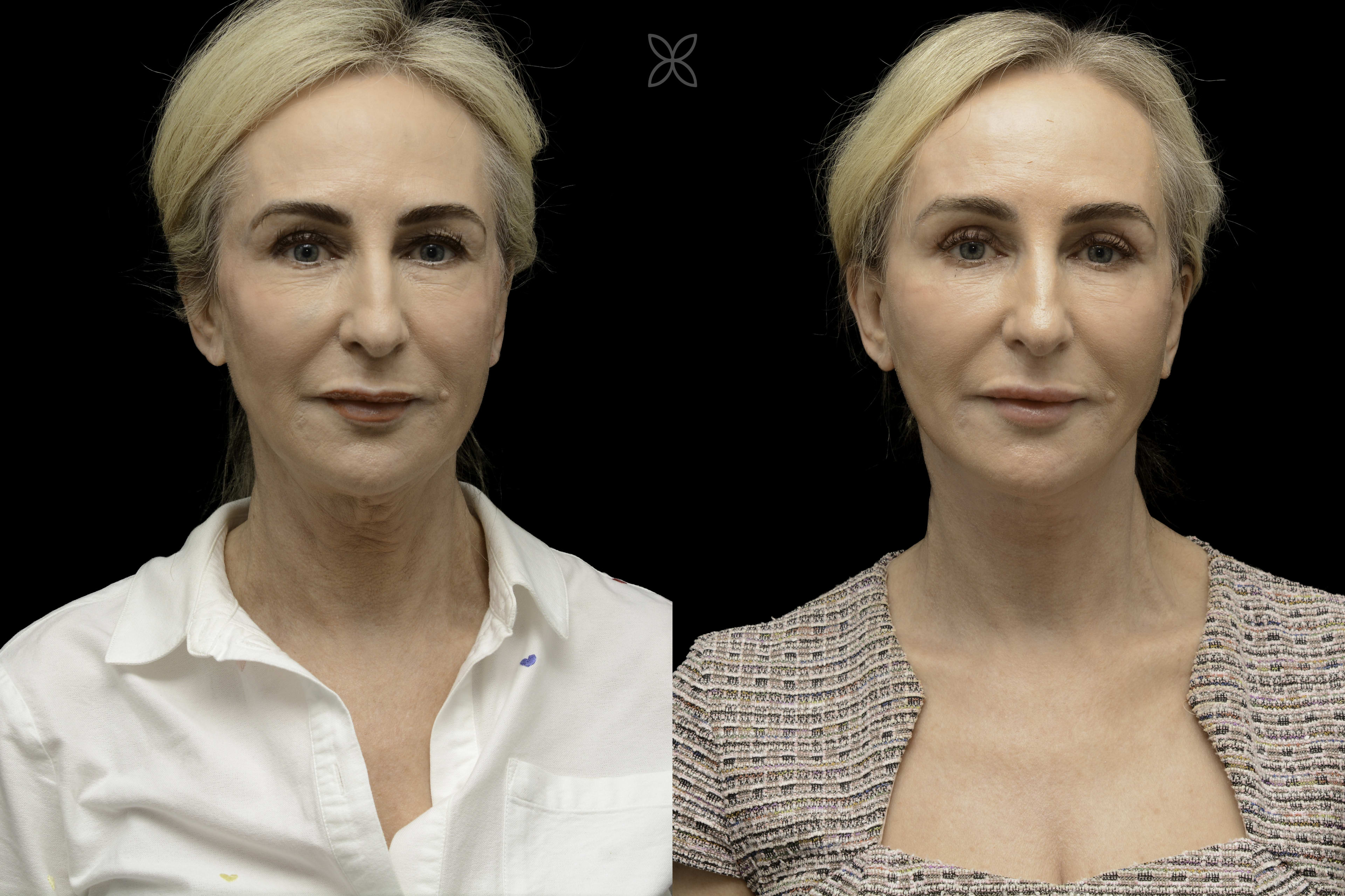 Deep Plane Facelift Newport Beach
