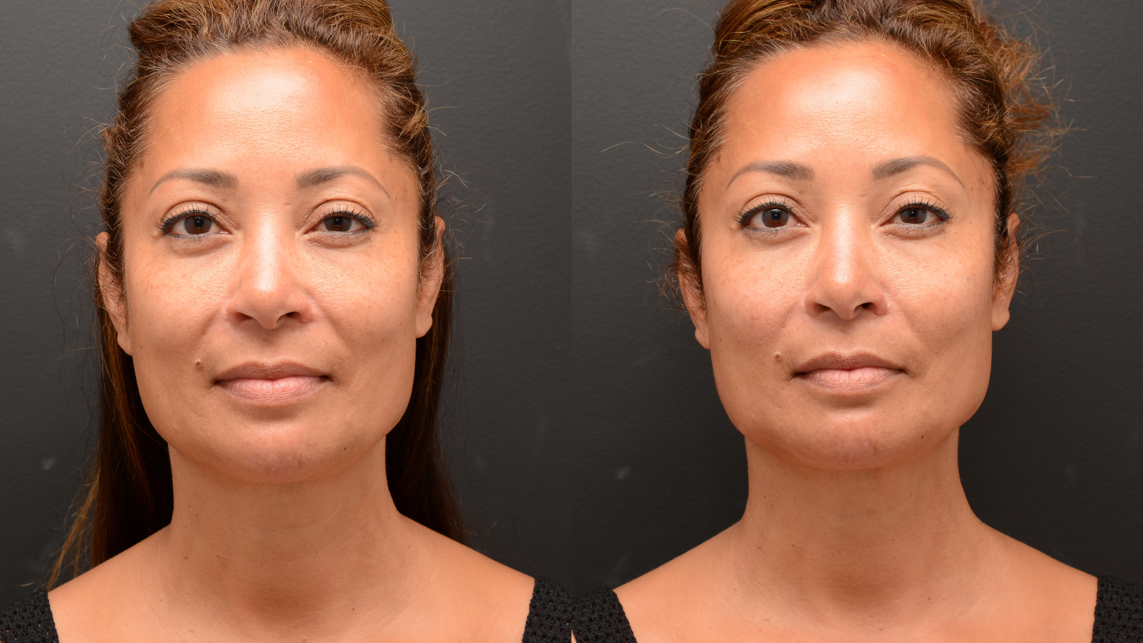 Thread Lift Procedures