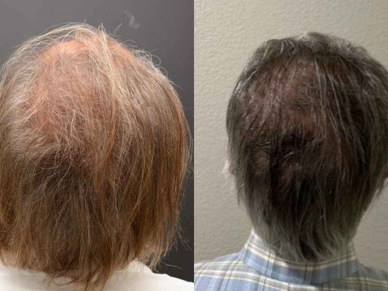 Patient A &mdash; NeoGraft FUE before and after